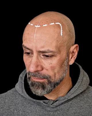 Avant la micropigmentation capillaire, avec ligne frontale dessinée