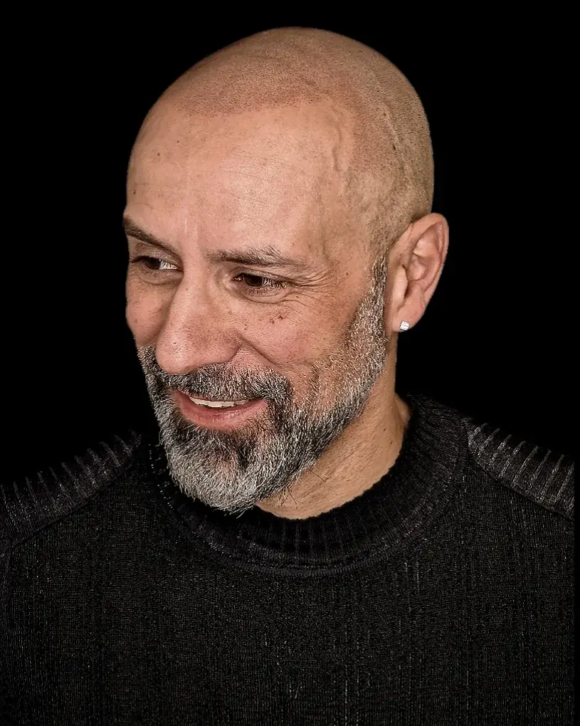 Résultat de micropigmentation capillaire effet rasé sur une calvitie, réalisé par Julien Maret