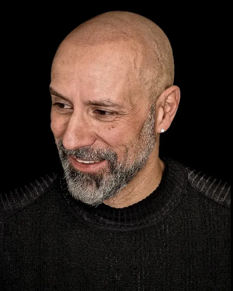 Résultat de micropigmentation capillaire effet rasé sur une calvitie, réalisé par Julien Maret