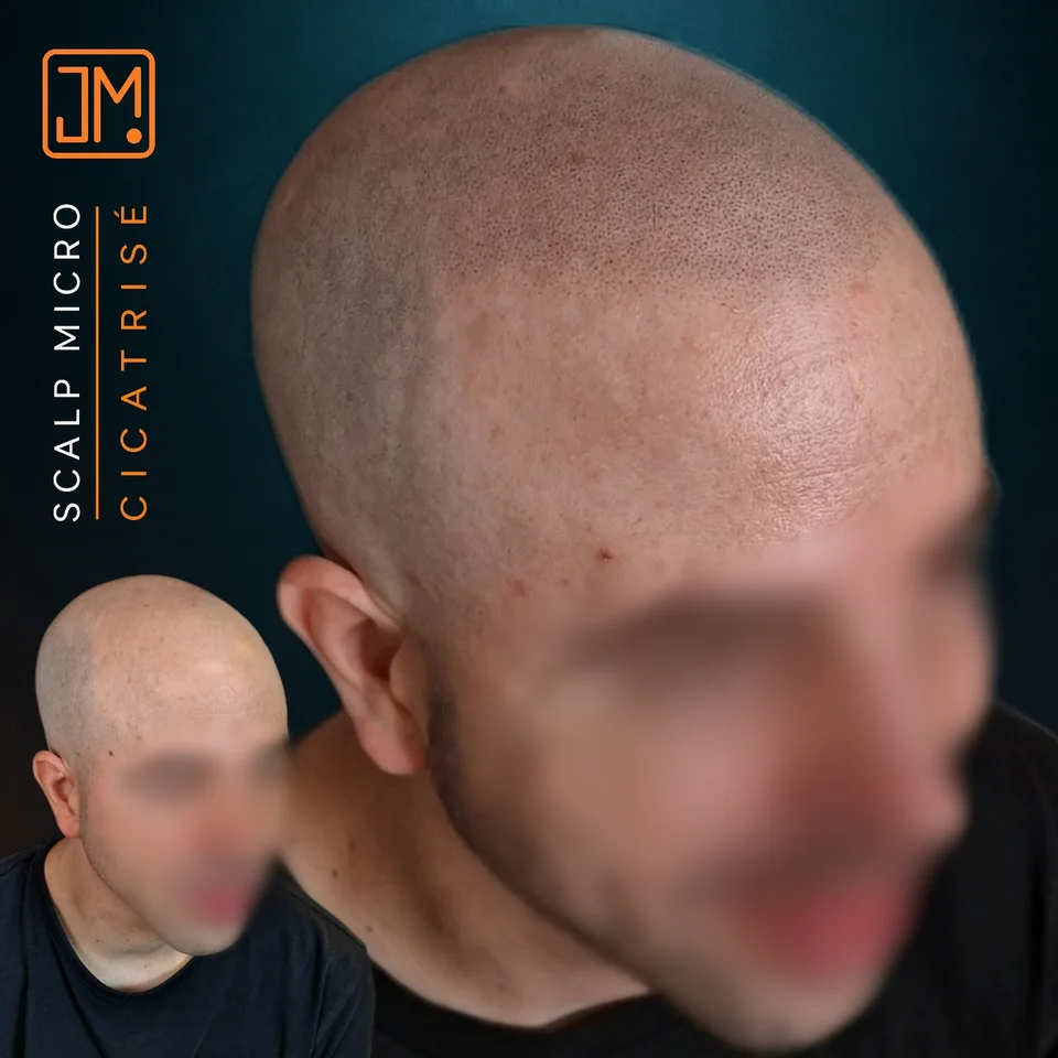 Micropigmentation capillaire : résultat cicatrisé après 6 mois.