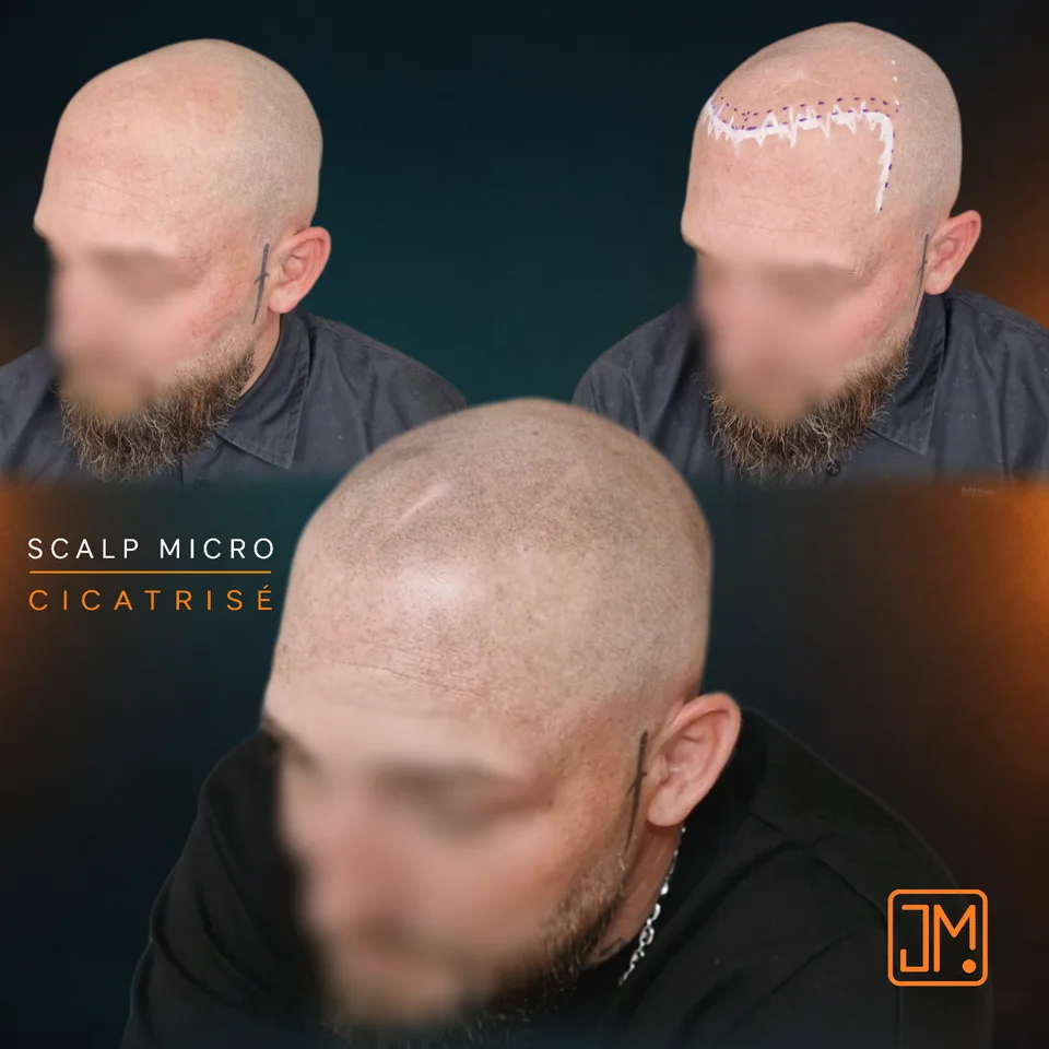 Micropigmentation capillaire : résultat cicatrisé avant retouche.