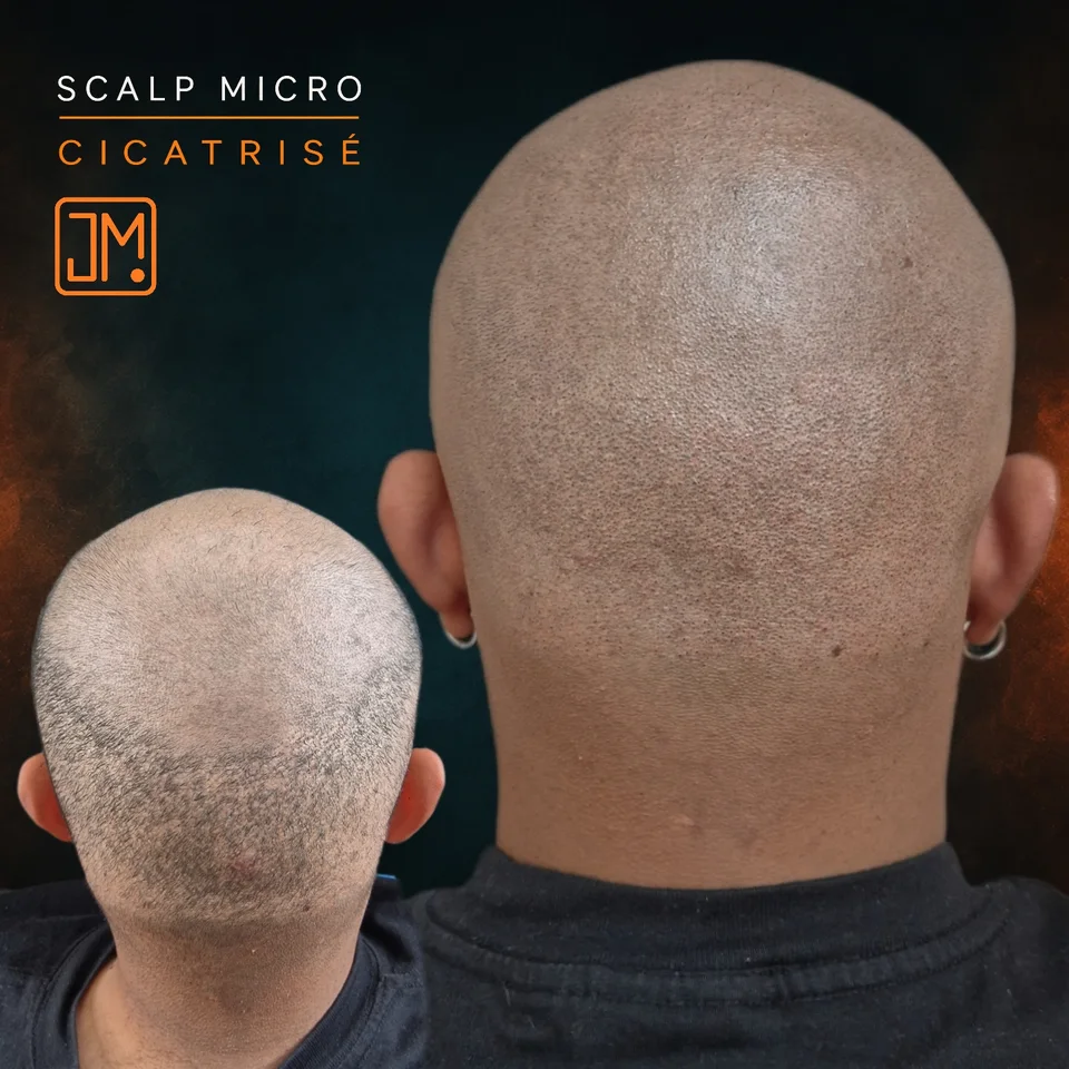 Micropigmentation capillaire : résultat cicatrisé sur cicatrices de greffe.