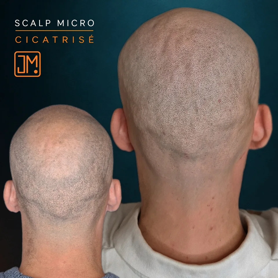 Micropigmentation capillaire : résultat cicatrisé sur cicatrices de greffe avant retouche.