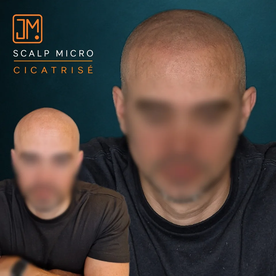 Micropigmentation capillaire : résultat cicatrisé.