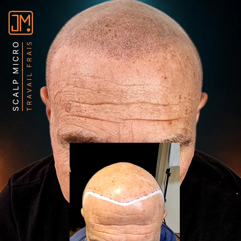 Micropigmentation capillaire : travail frais.