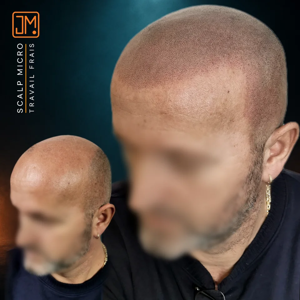 Micropigmentation capillaire : travail frais.