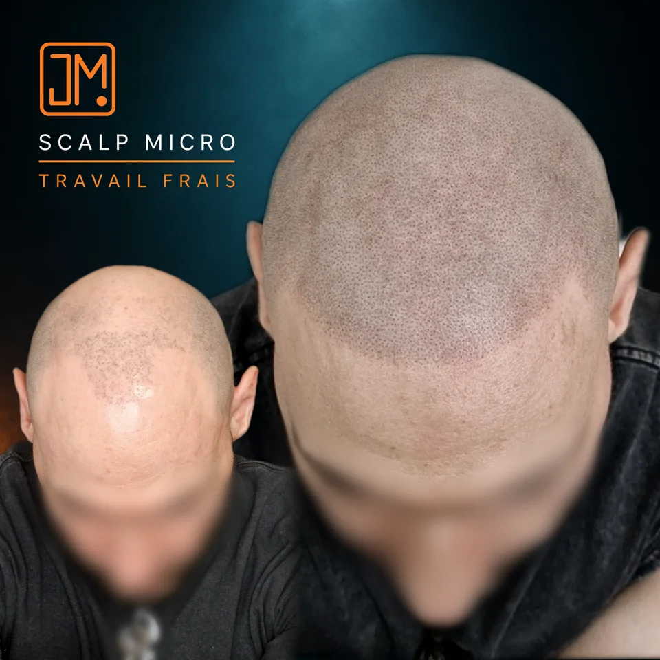 Micropigmentation capillaire : travail frais.