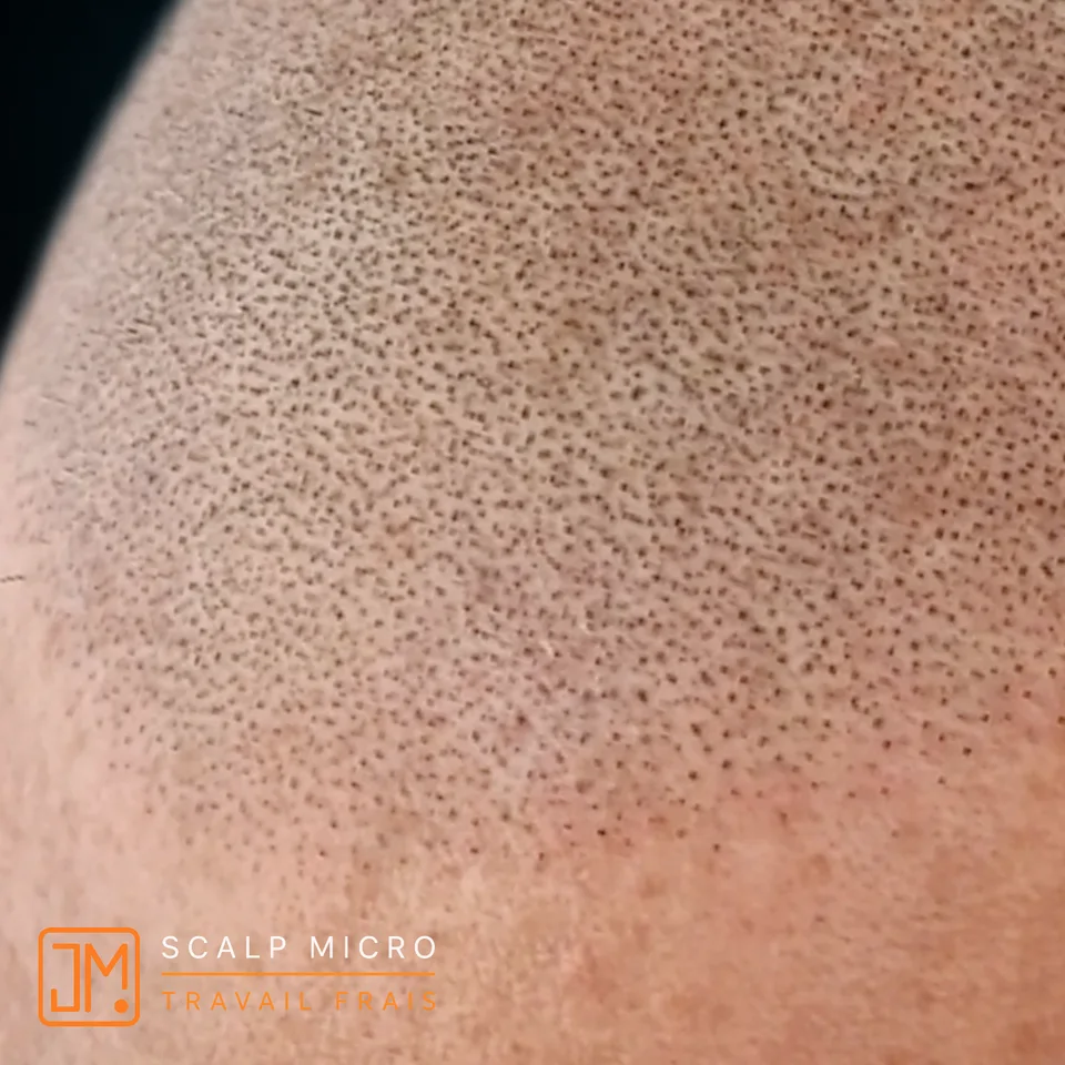 Micropigmentation capillaire : travail frais.