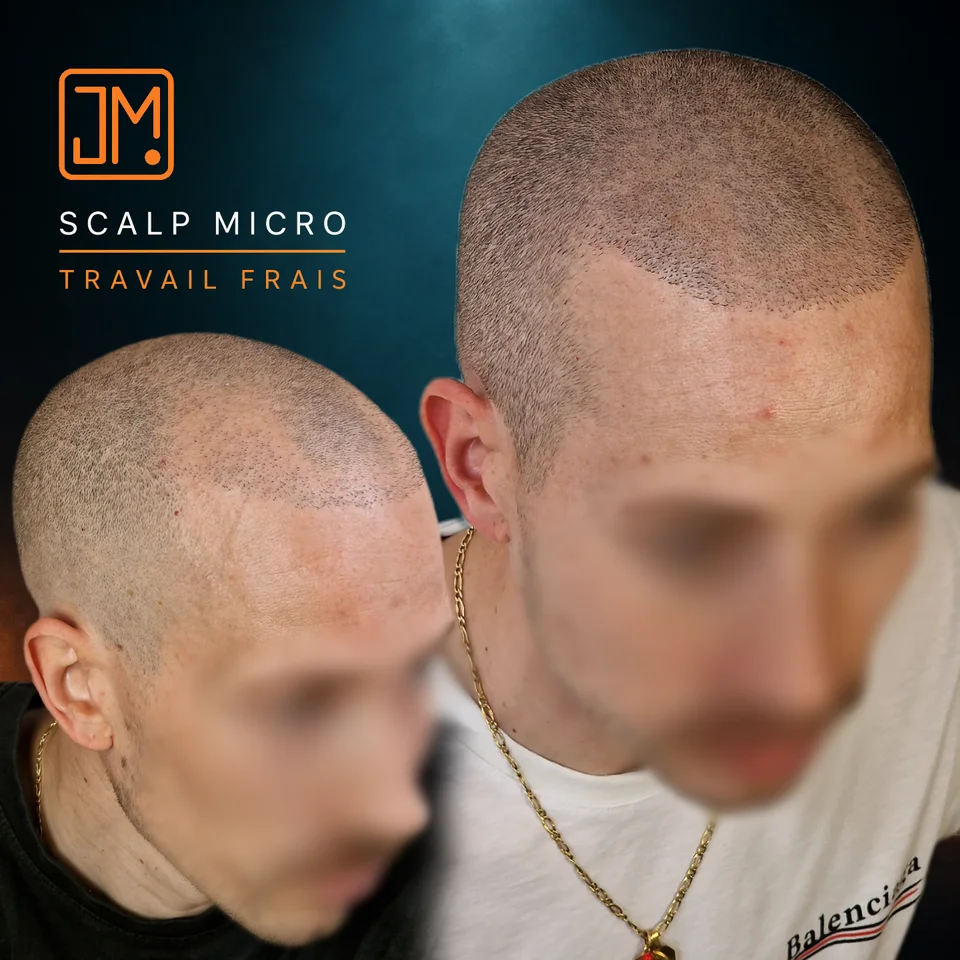 Micropigmentation capillaire : travail frais avec densification capillaire.