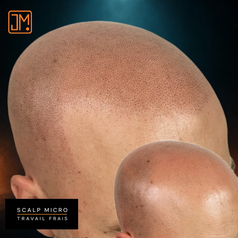 Micropigmentation capillaire : aspect frais après une première séance.
