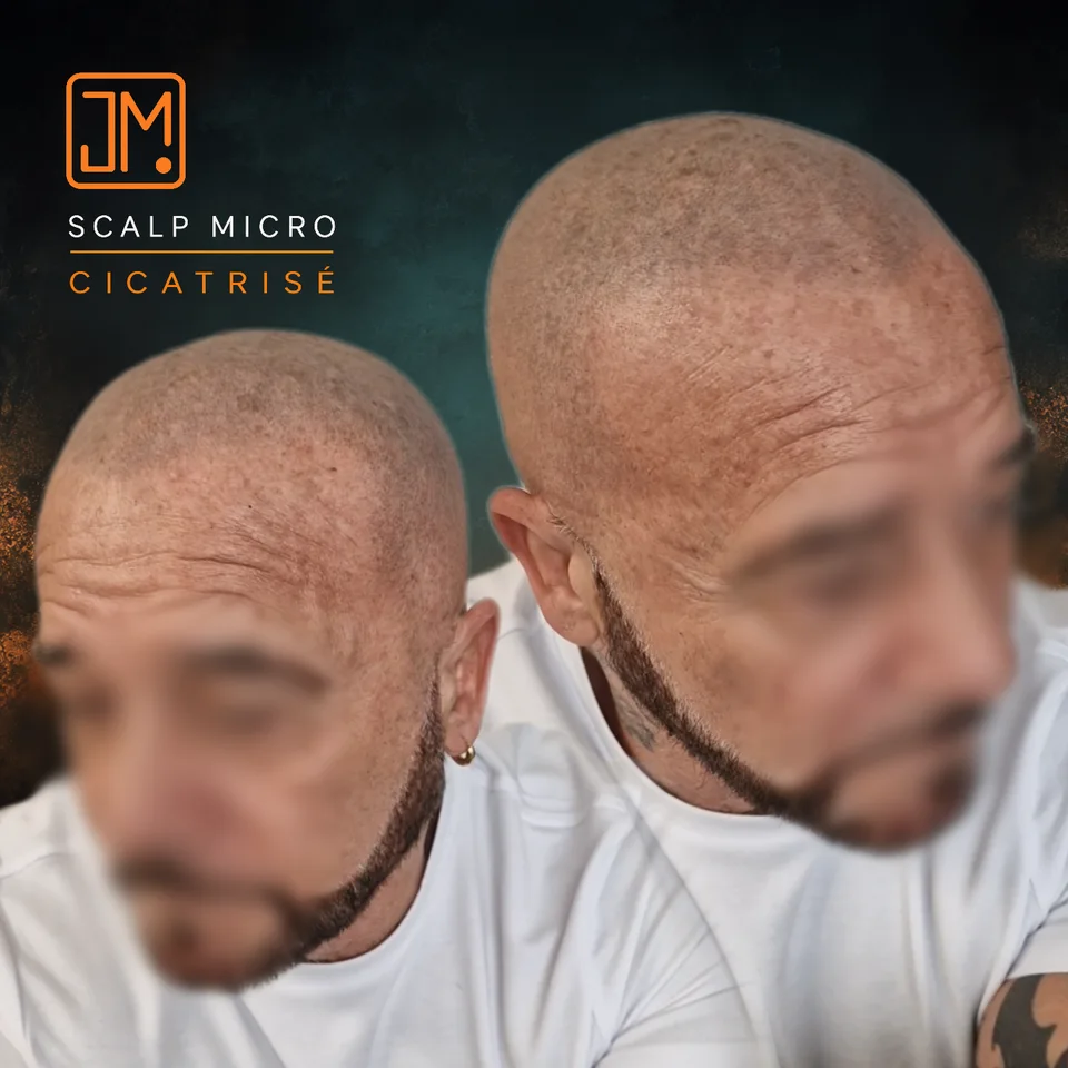 Micropigmentation capillaire : résultat cicatrisé avant retouche.