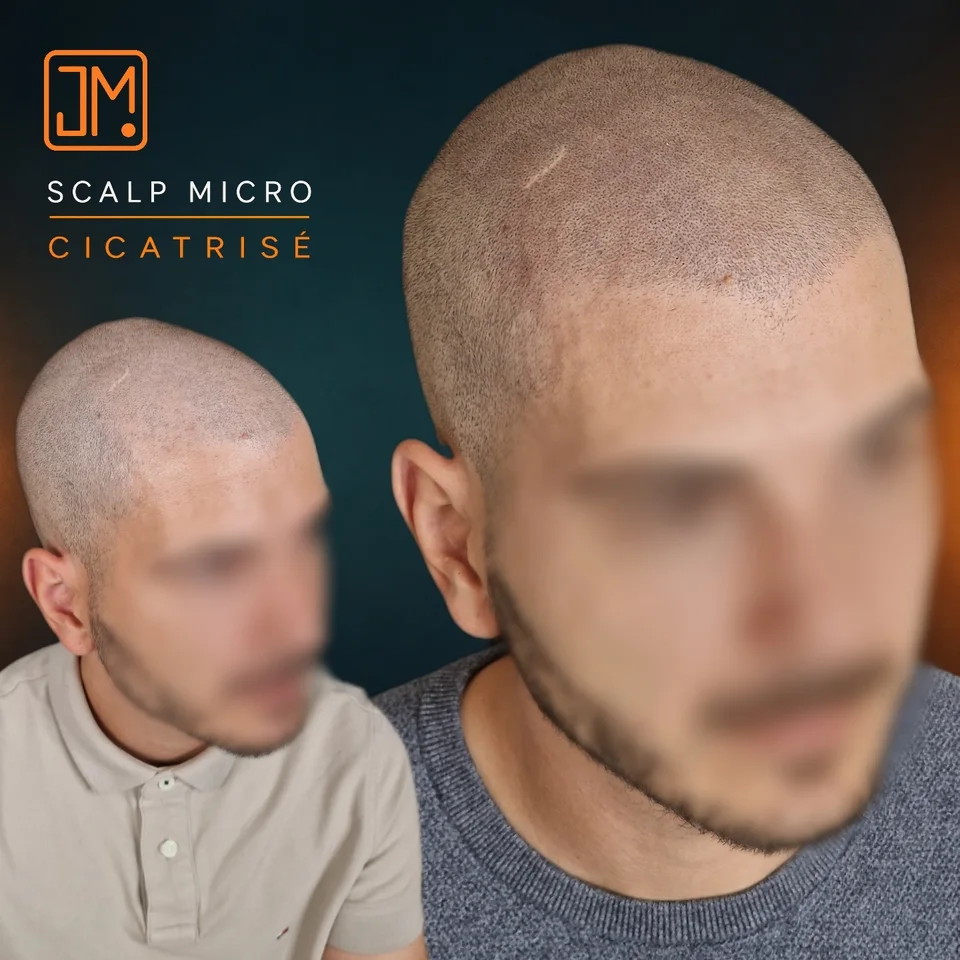 Micropigmentation capillaire : résultat cicatrisé avec densification capillaire.