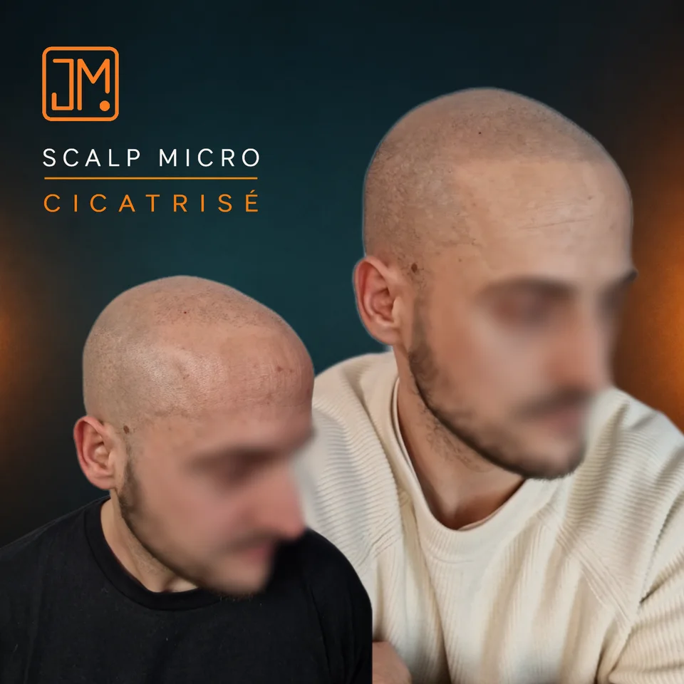 Micropigmentation capillaire : résultat cicatrisé sur zone greffée avant retouche.