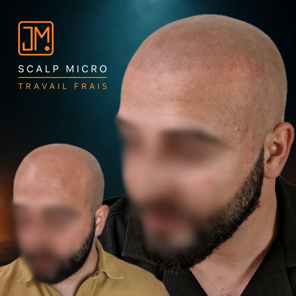 Micropigmentation capillaire : travail frais.
