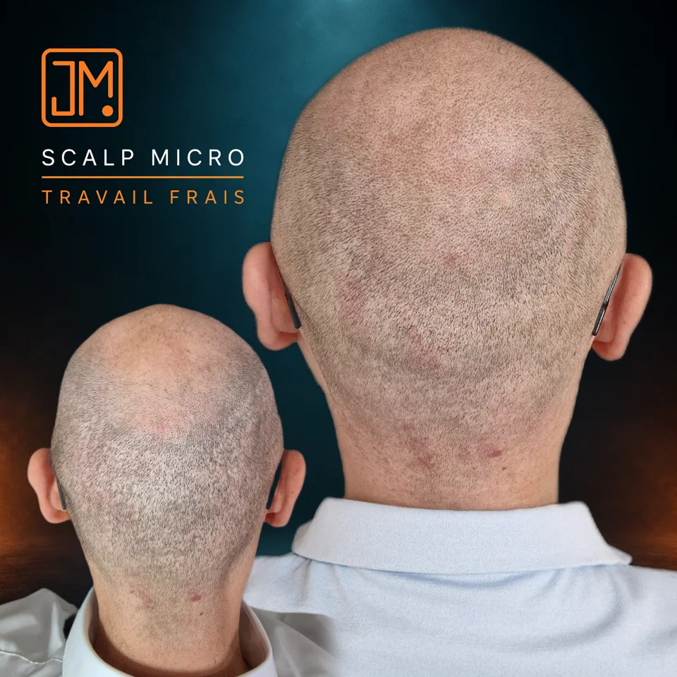 Micropigmentation capillaire : travail frais sur cicatrices de greffe.