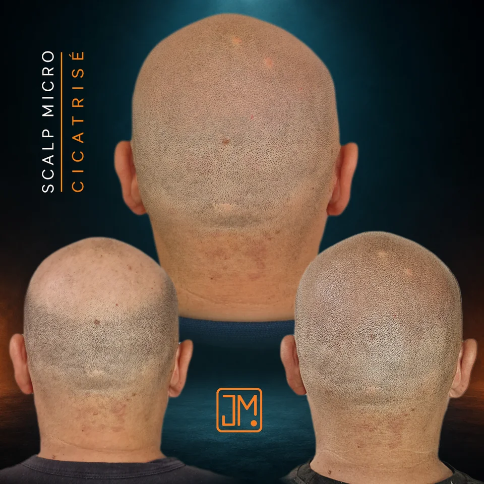 Micropigmentation capillaire : résultat cicatrisé après 3 ans avant retouche, puis aspect frais après retouche.