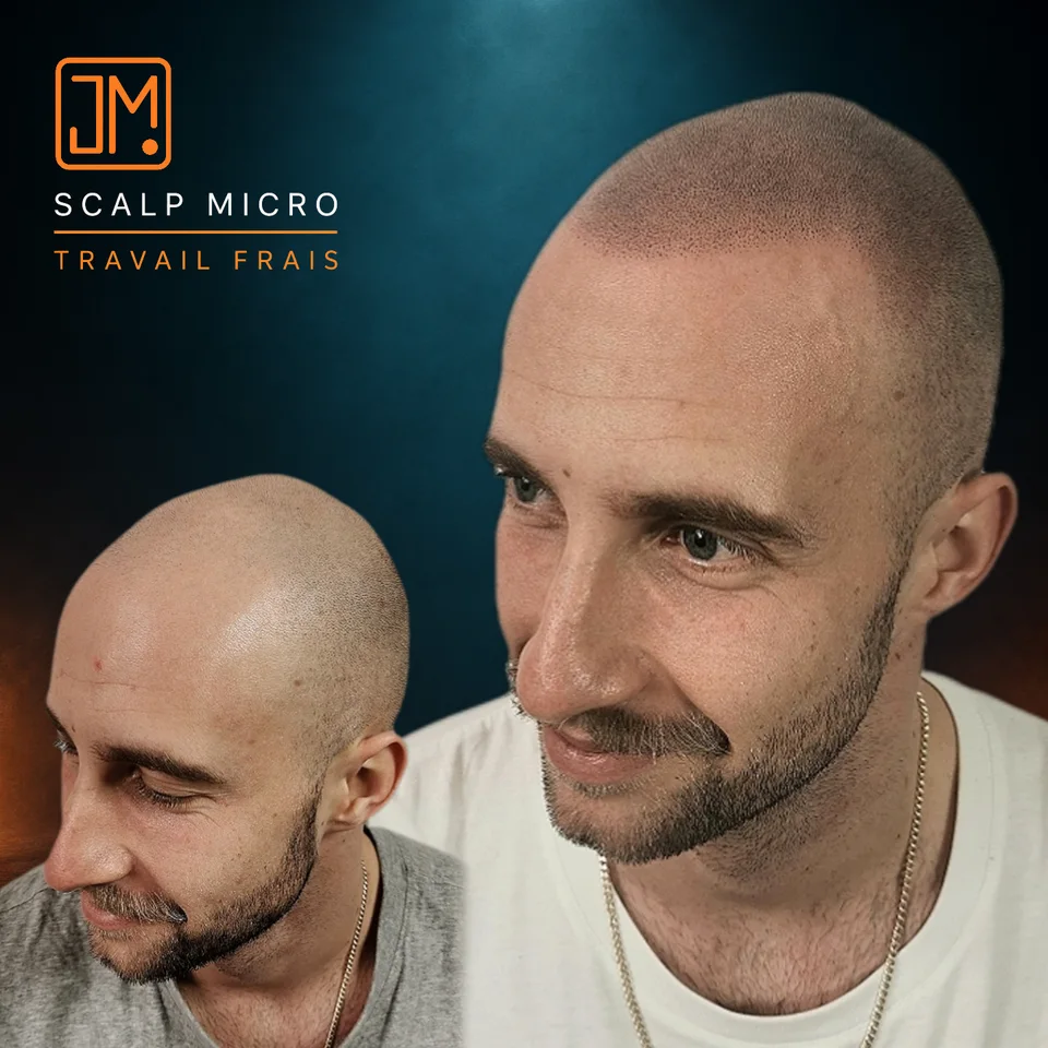Micropigmentation capillaire : travail frais.
