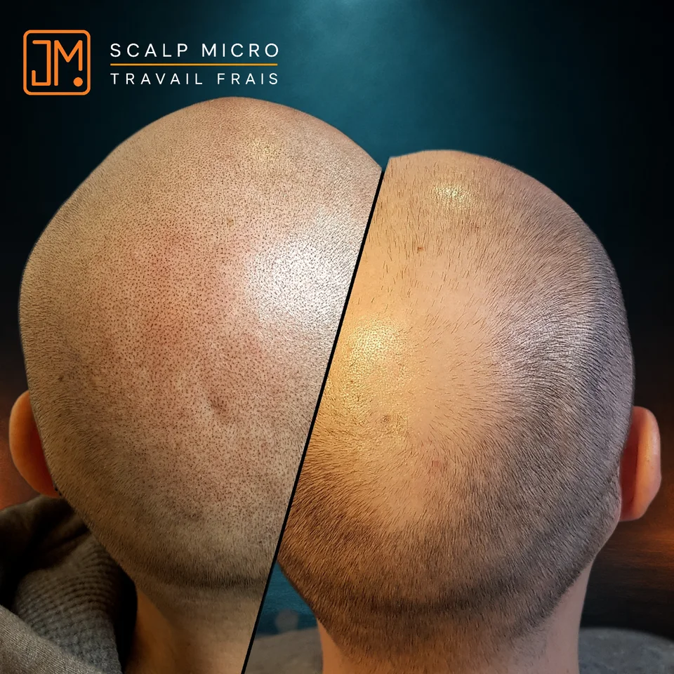 Micropigmentation capillaire : travail frais.