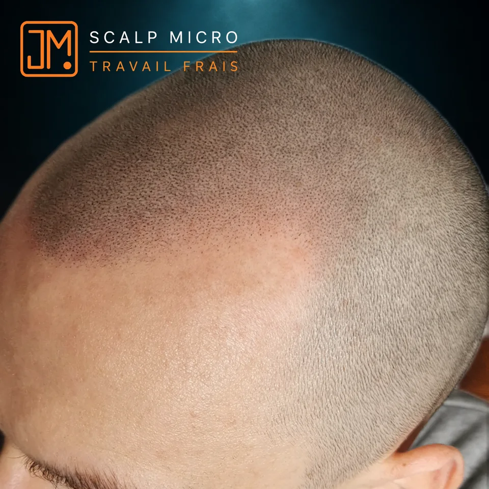 Micropigmentation capillaire : travail frais avec densification capillaire.