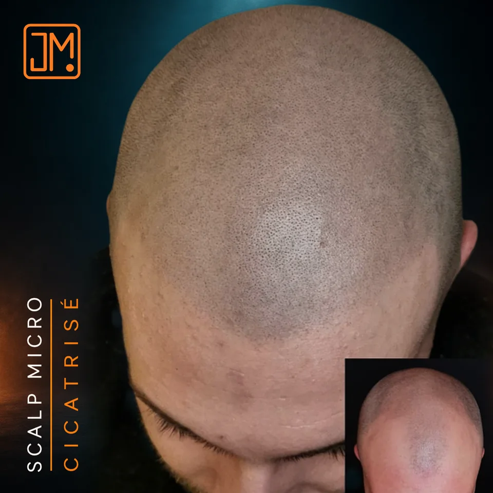 Micropigmentation capillaire : résultat cicatrisé après 4 ans.