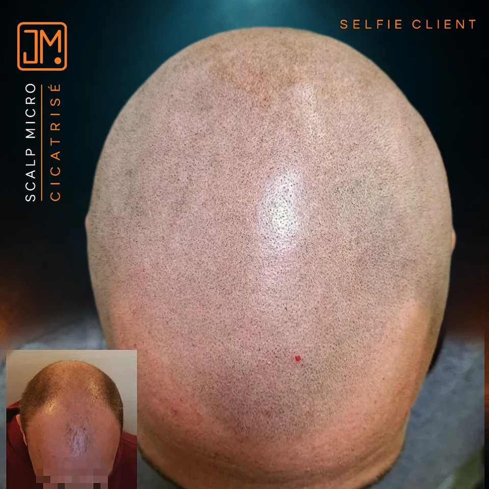 Micropigmentation capillaire : résultat cicatrisé, photo prise par le client.