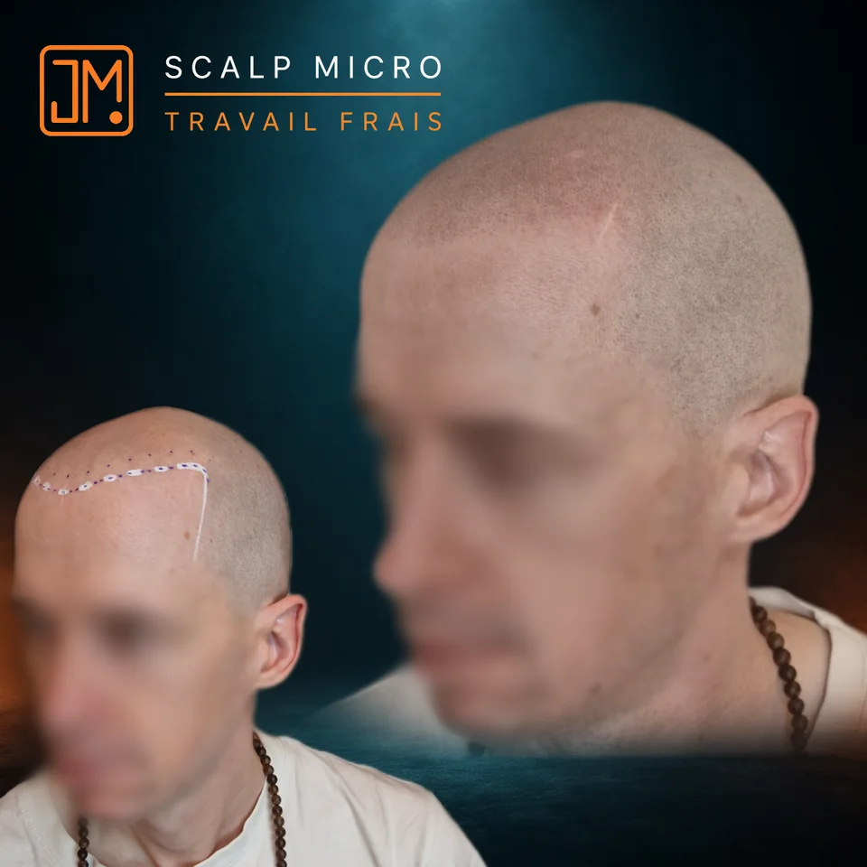 Micropigmentation capillaire : travail frais.