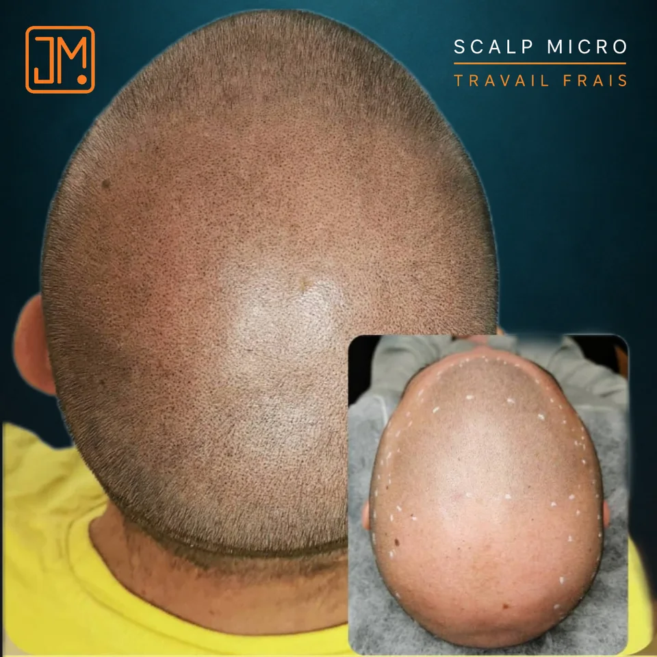 Micropigmentation capillaire : travail frais.