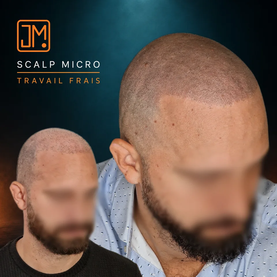 Micropigmentation capillaire : travail frais avec densification capillaire.