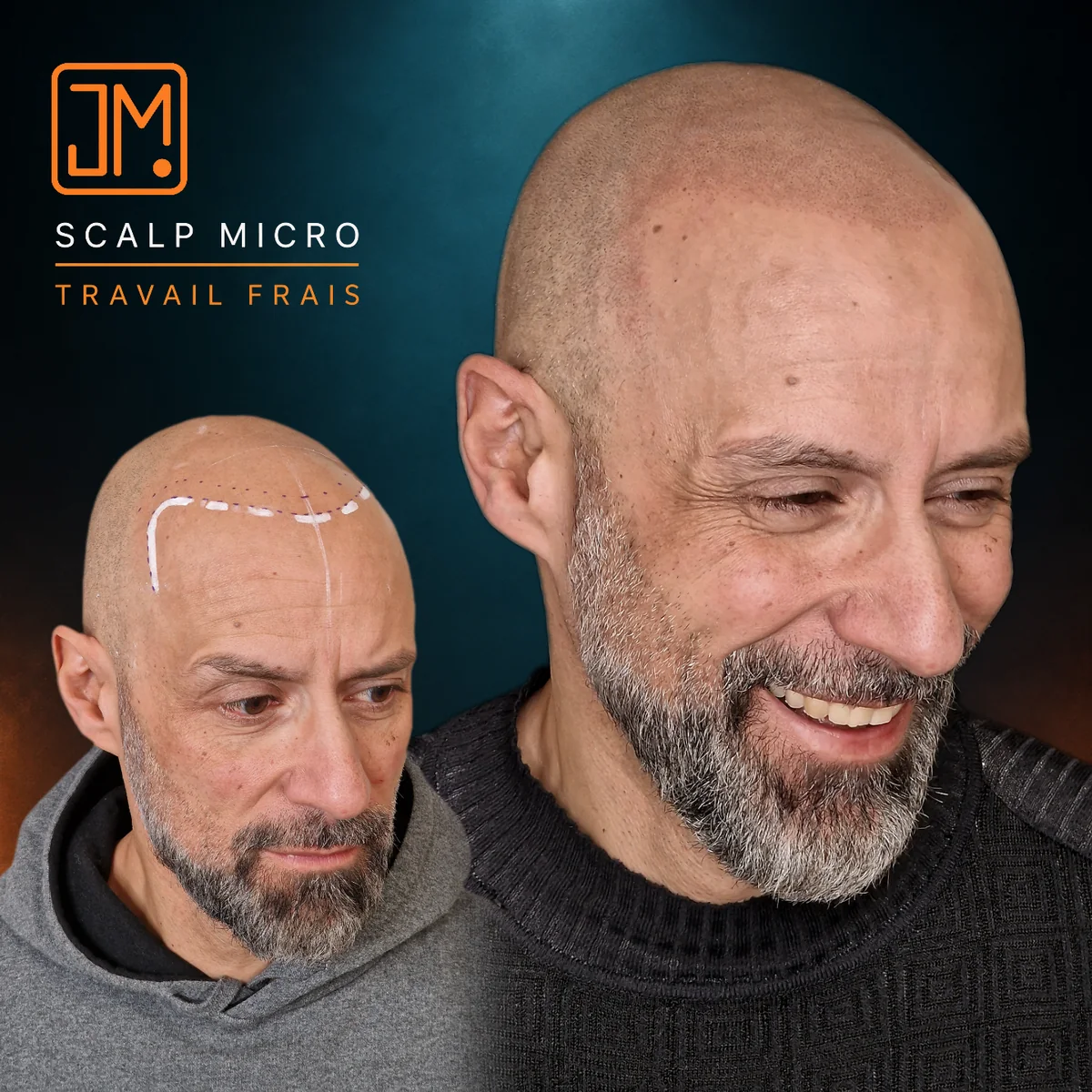 Micropigmentation capillaire JM.Micro, travail frais — cas 01