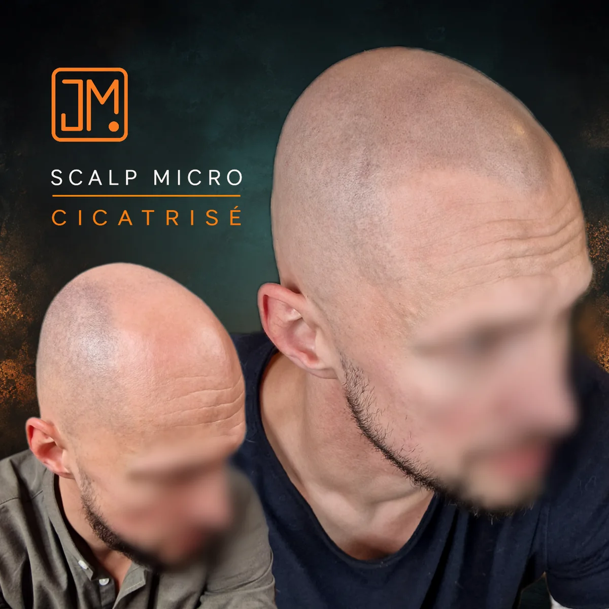Résultat cicatrisé de micropigmentation capillaire JM.Micro, vue de trois quarts