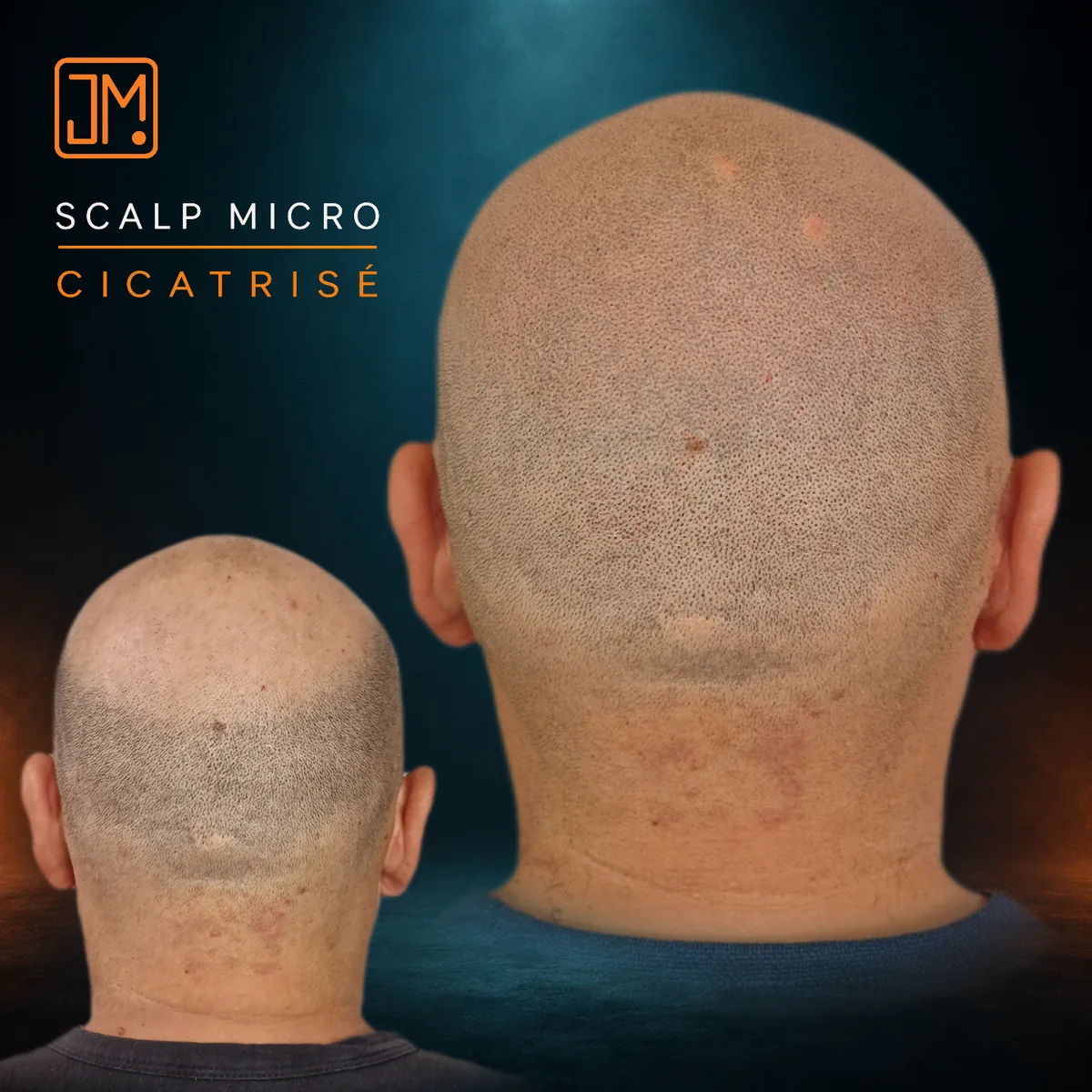 Résultat cicatrisé de micropigmentation capillaire JM.Micro, vue latérale