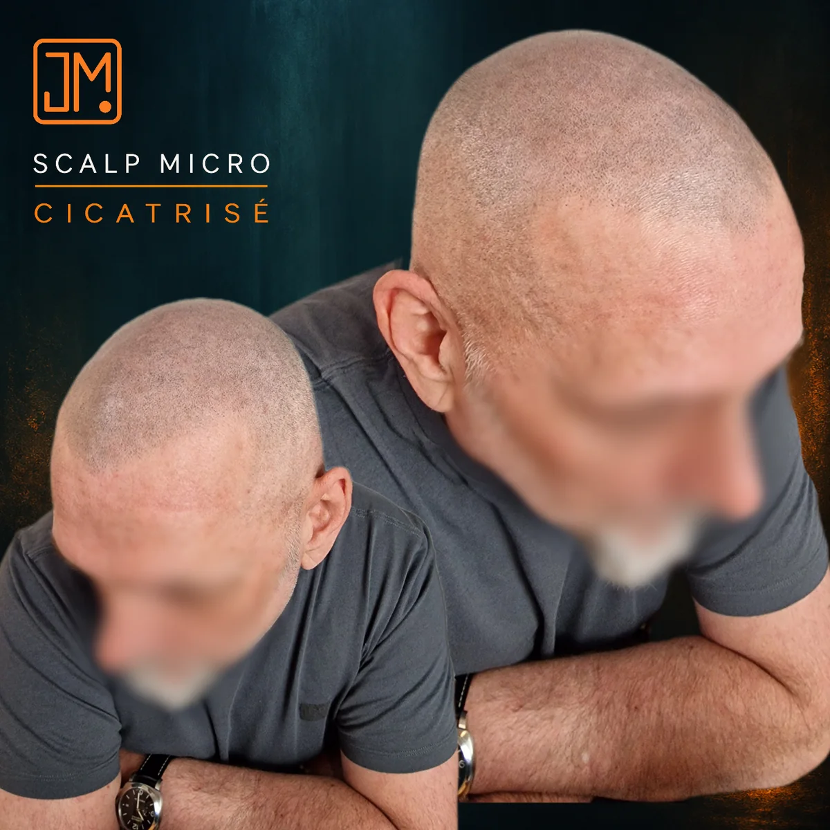 Résultat cicatrisé de micropigmentation capillaire JM.Micro — cas 04