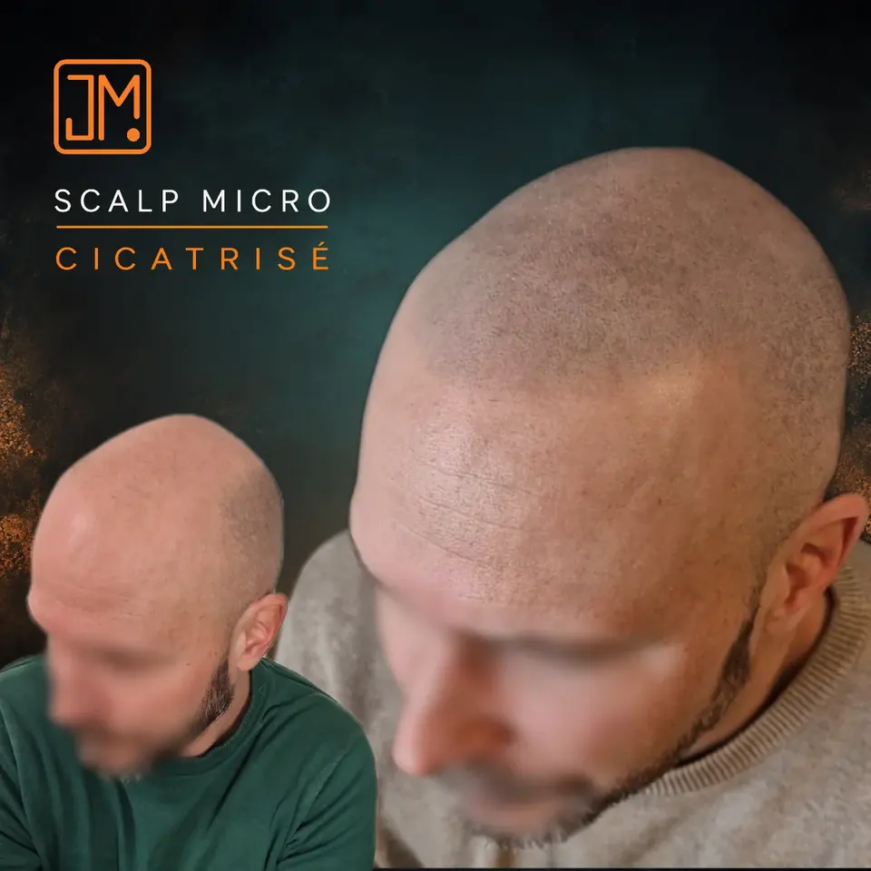 Résultat cicatrisé de micropigmentation capillaire JM.Micro, cas 06