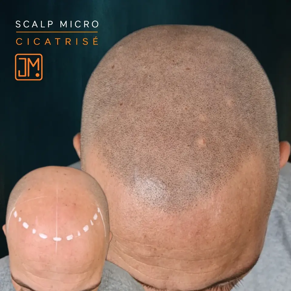 Résultat cicatrisé de micropigmentation capillaire JM.Micro, arrière du crâne