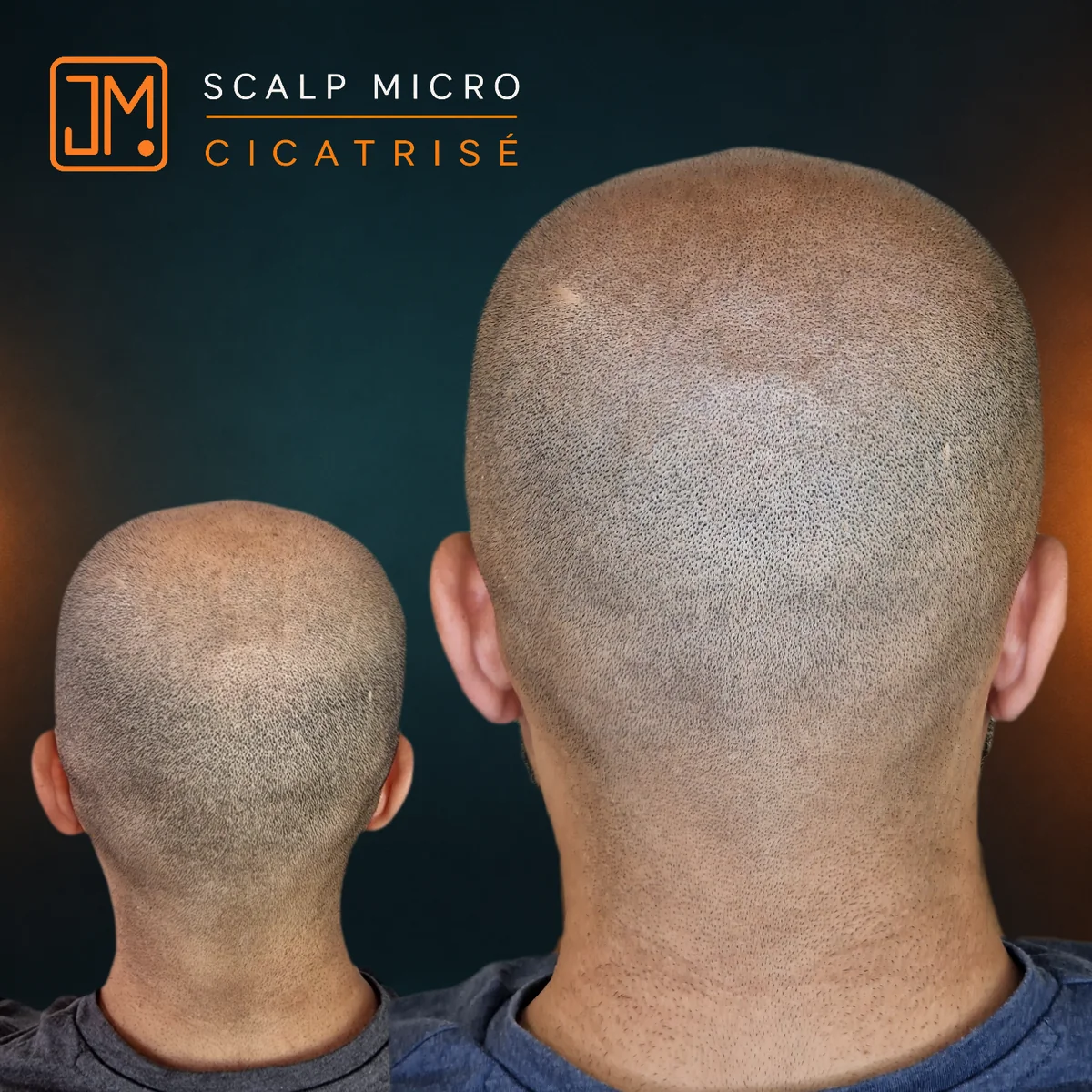 Résultat cicatrisé de micropigmentation capillaire JM.Micro, vue en plongée