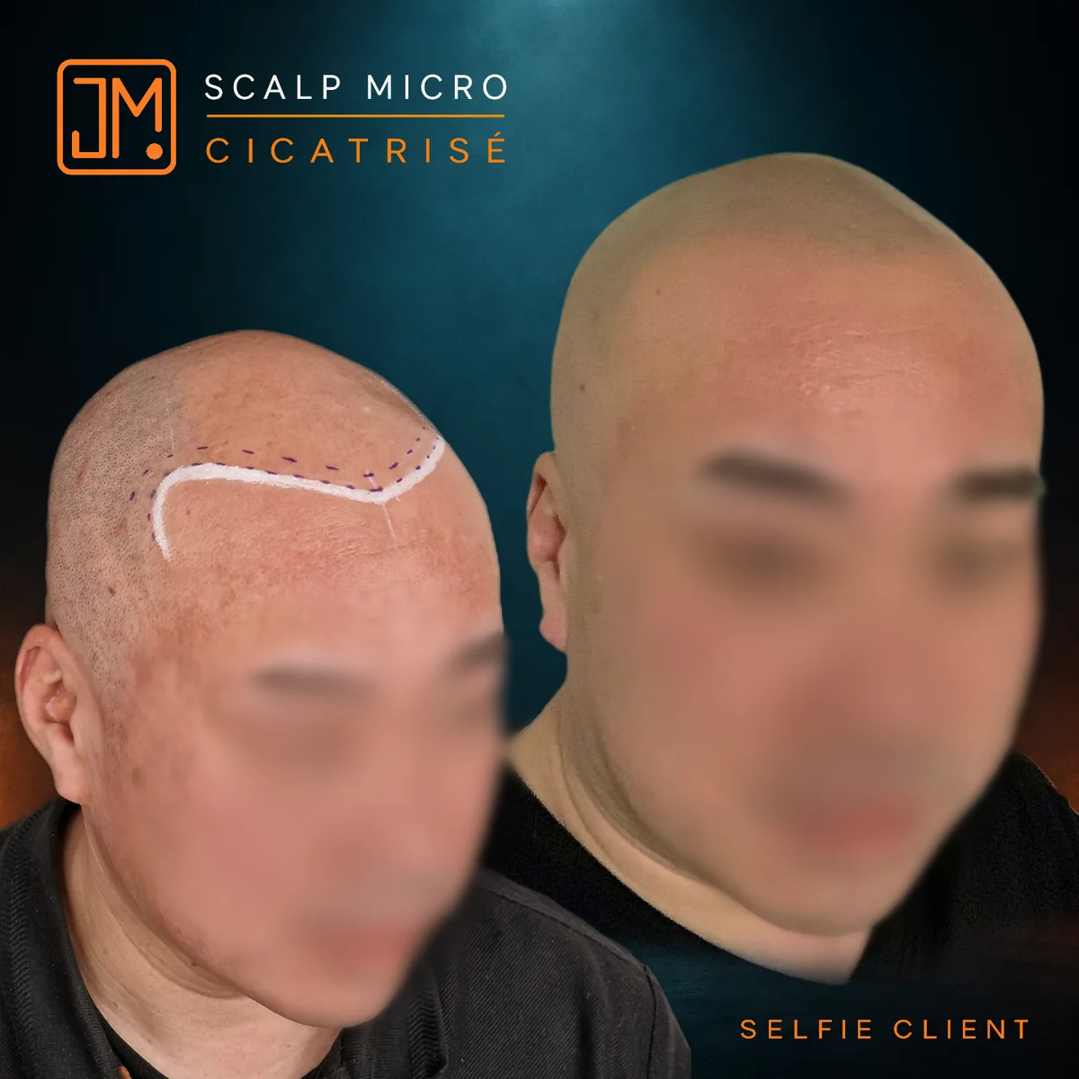 Résultat cicatrisé de micropigmentation capillaire JM.Micro, selfie client
