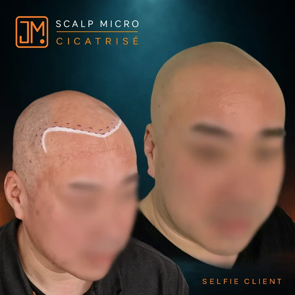 Résultat cicatrisé de micropigmentation capillaire JM.Micro, selfie client