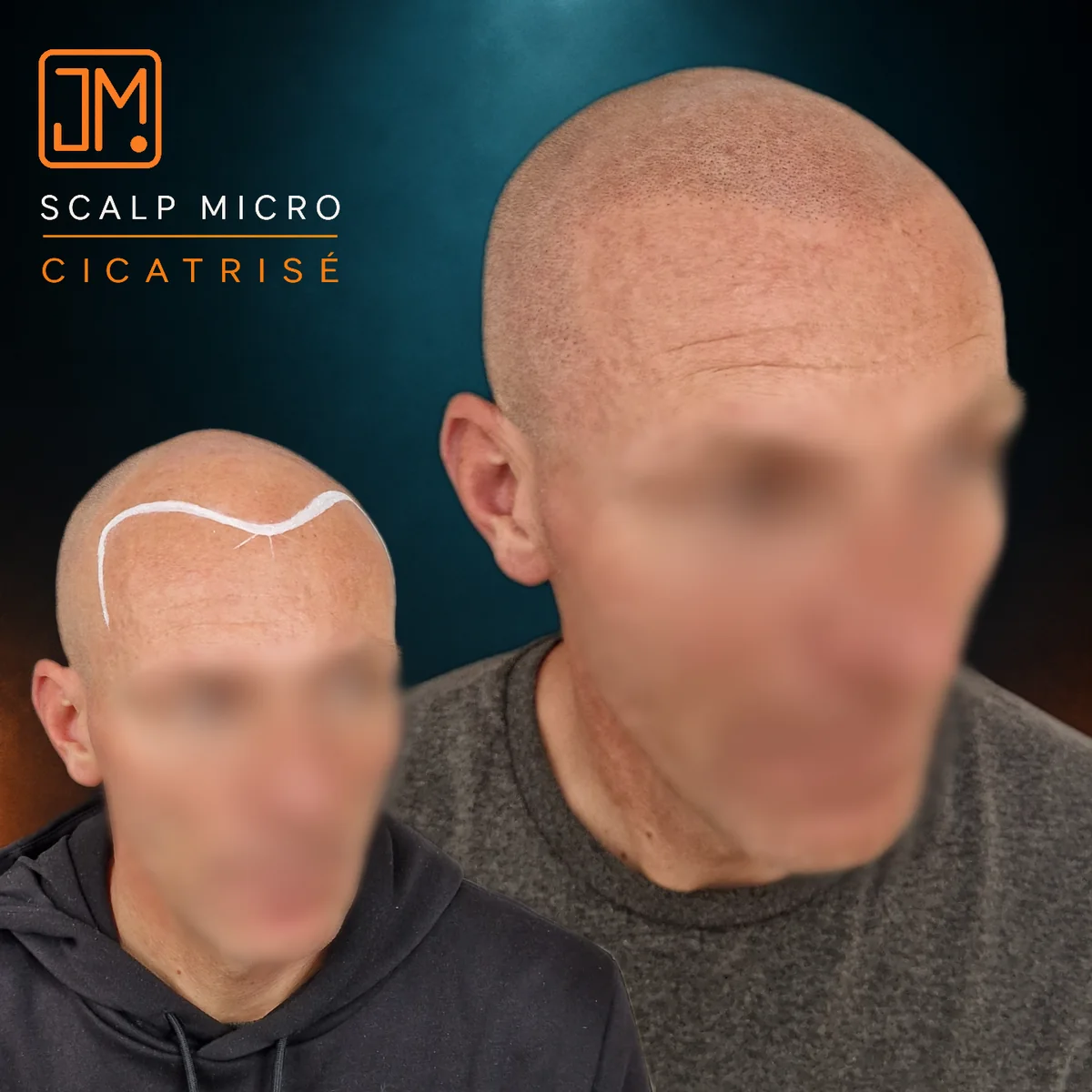 Résultat cicatrisé de micropigmentation capillaire JM.Micro — cas 11