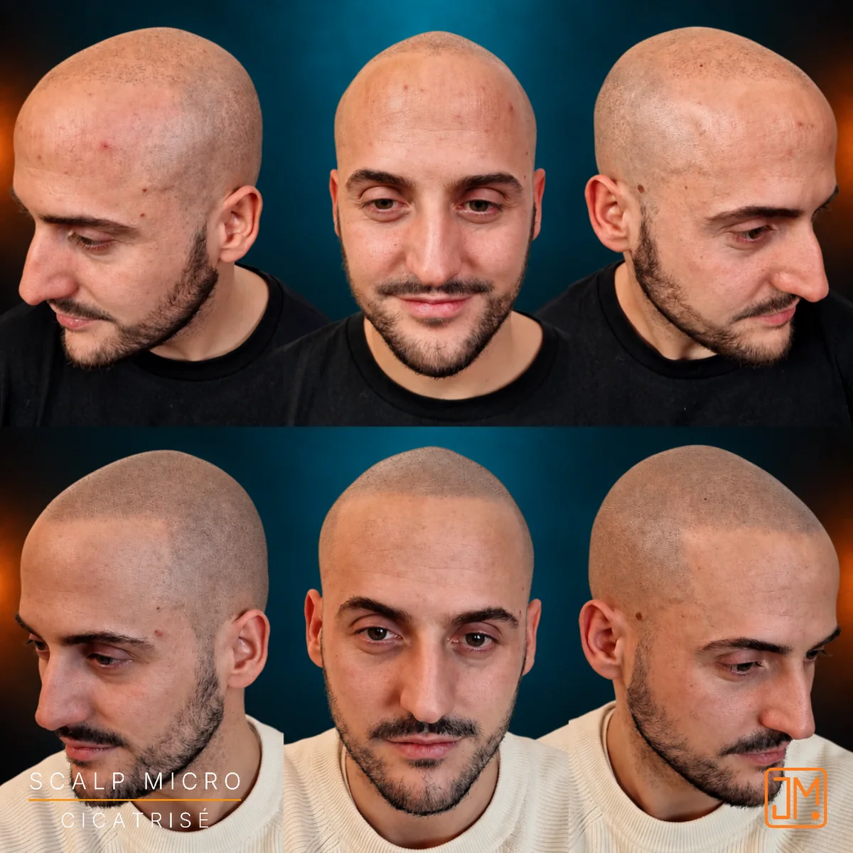 Résultat cicatrisé de micropigmentation capillaire JM.Micro — cas 12