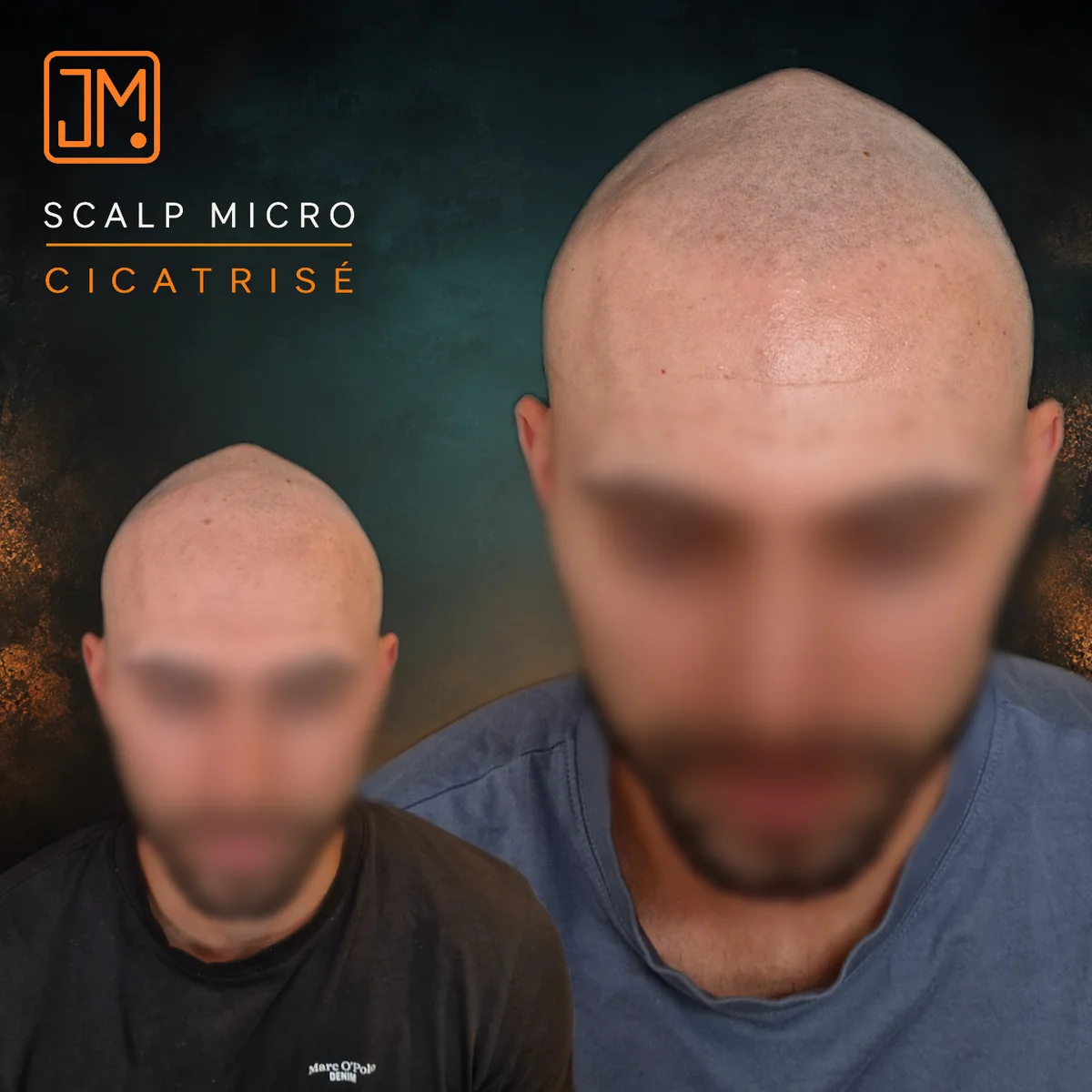 Résultat cicatrisé de micropigmentation capillaire JM.Micro — cas 13