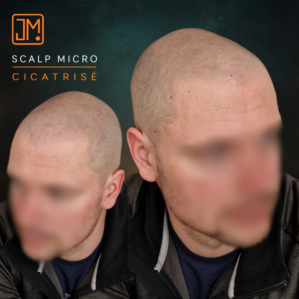 Résultat cicatrisé de micropigmentation capillaire JM.Micro — cas 14