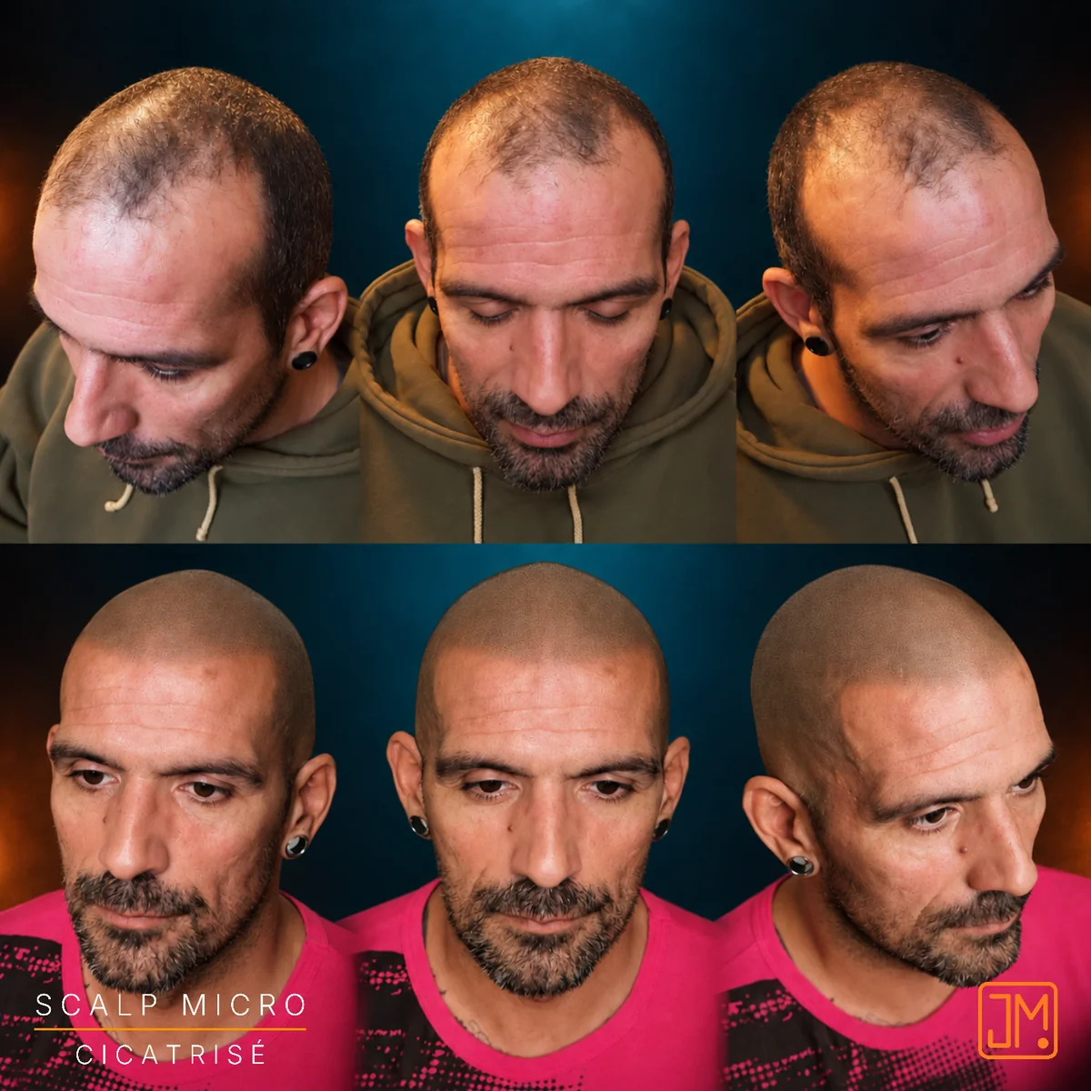 Avant et résultat cicatrisé d'une micropigmentation capillaire JM.Micro