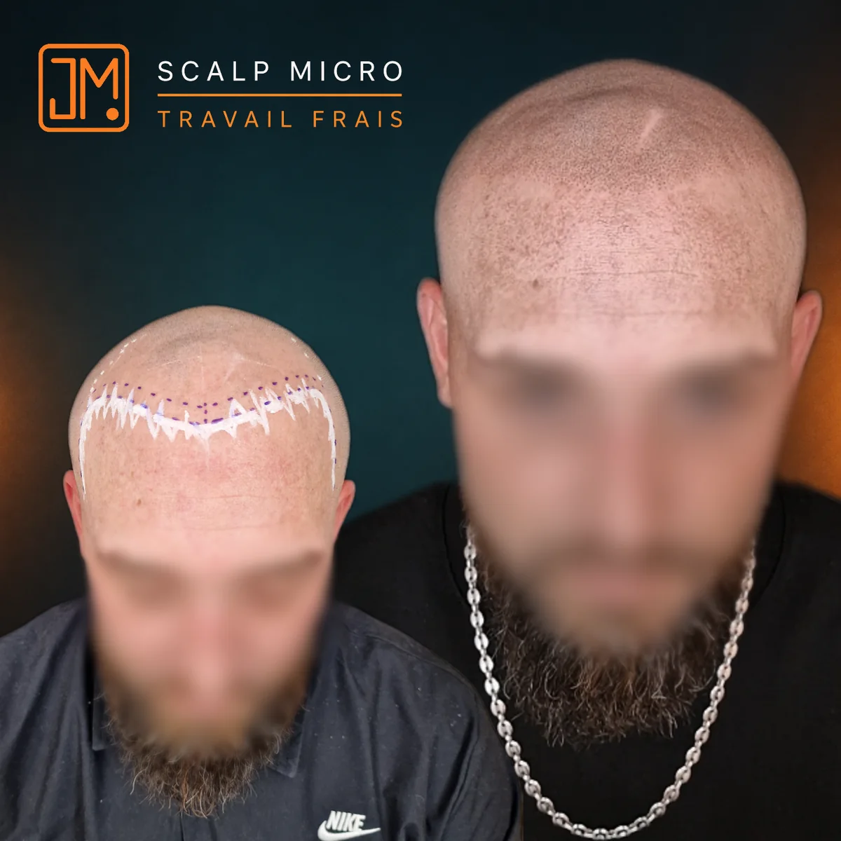 Micropigmentation capillaire JM.Micro, travail frais sur l'arrière du crâne — cas 16
