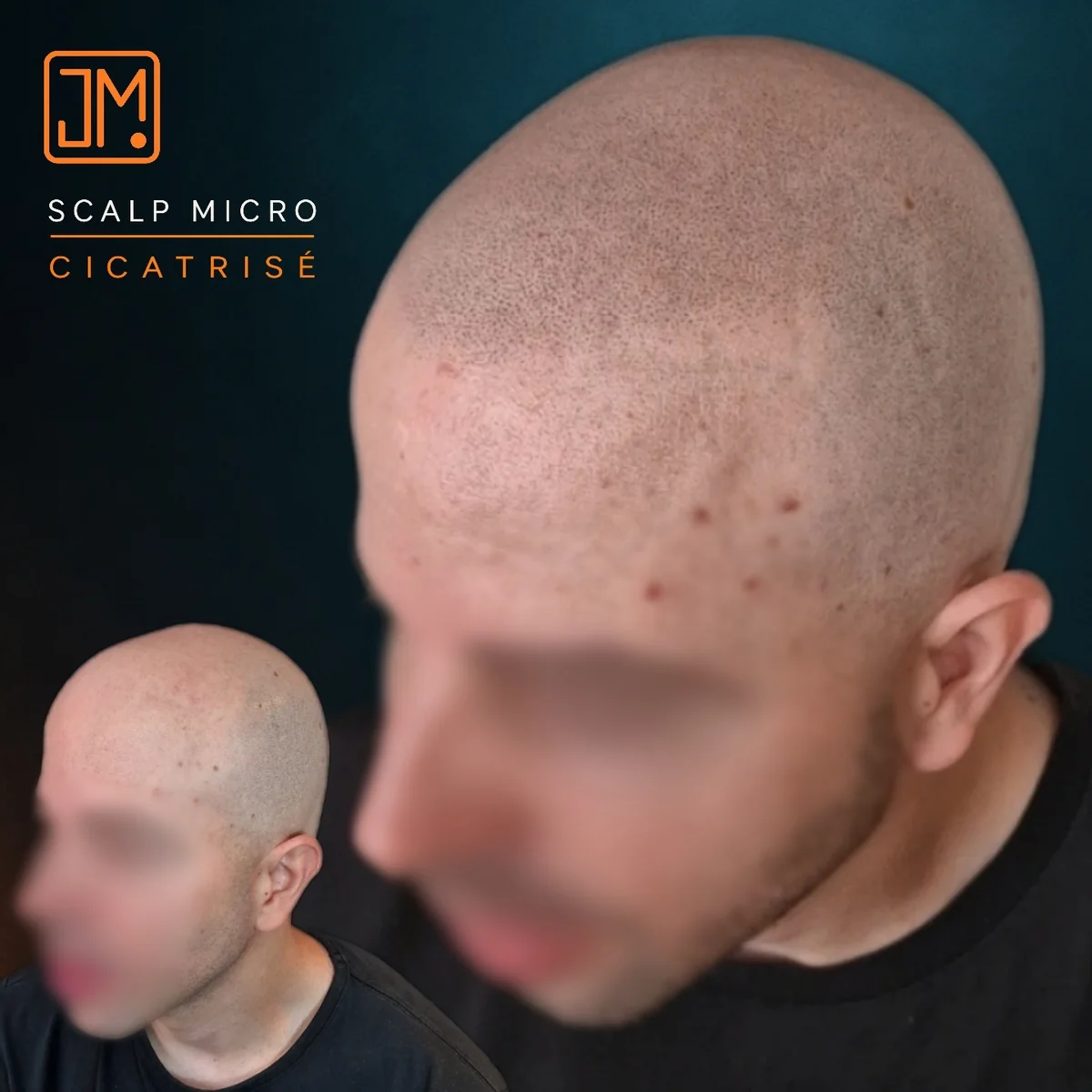 Résultat cicatrisé de micropigmentation capillaire JM.Micro — cas 18