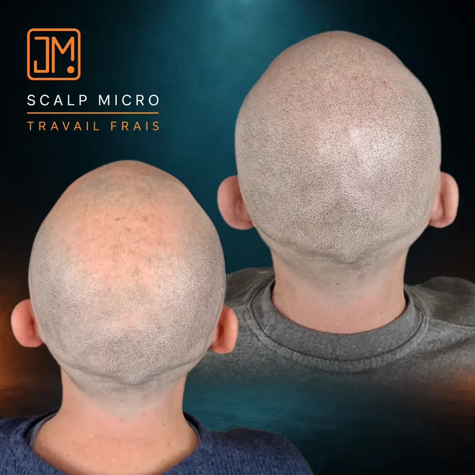 Micropigmentation capillaire JM.Micro, travail frais sur l'arrière du crâne, cas 19
