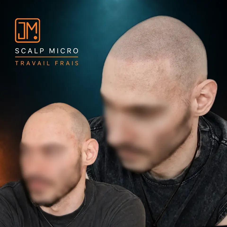 Micropigmentation capillaire JM.Micro, travail frais, cas 20