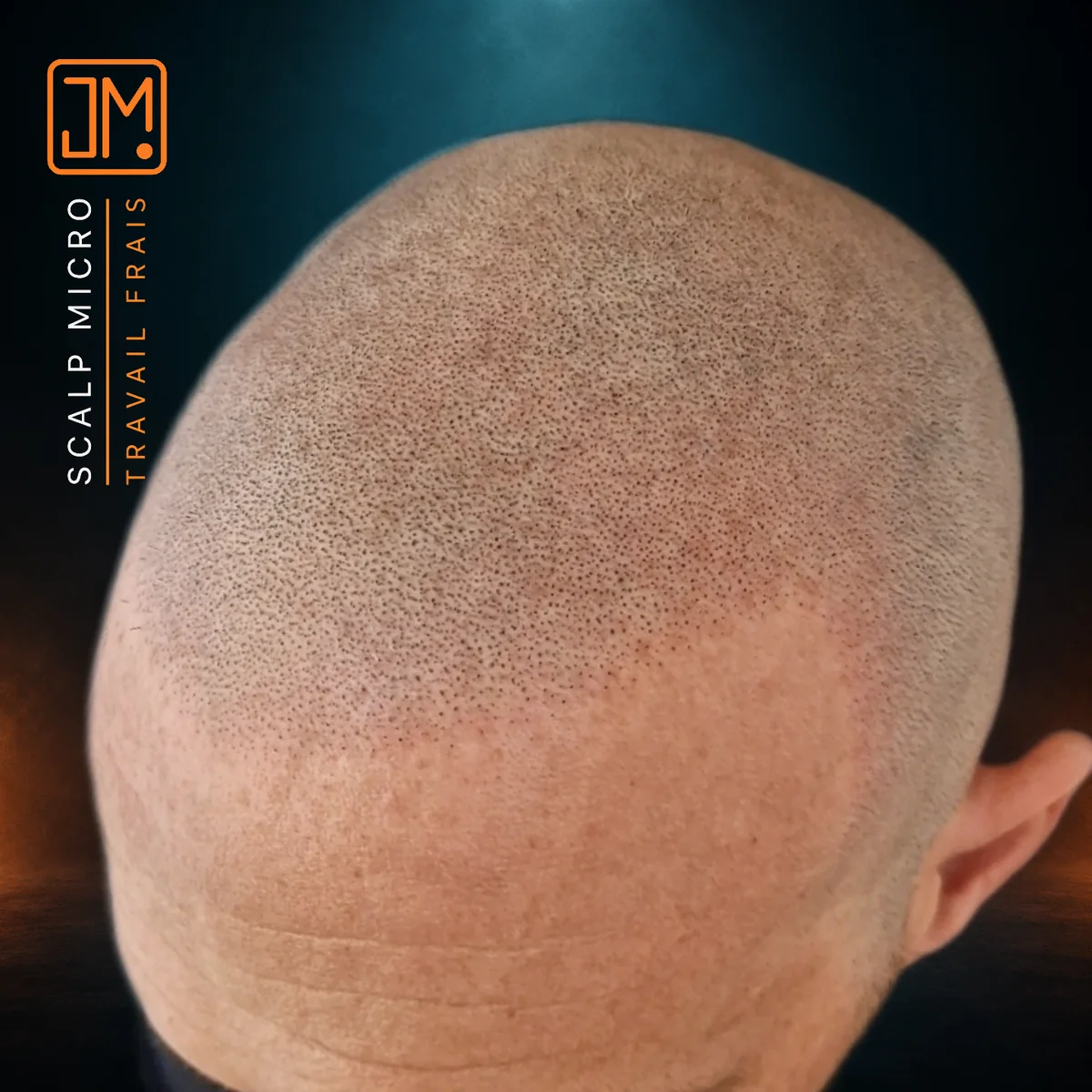 Micropigmentation capillaire JM.Micro, travail frais en gros plan