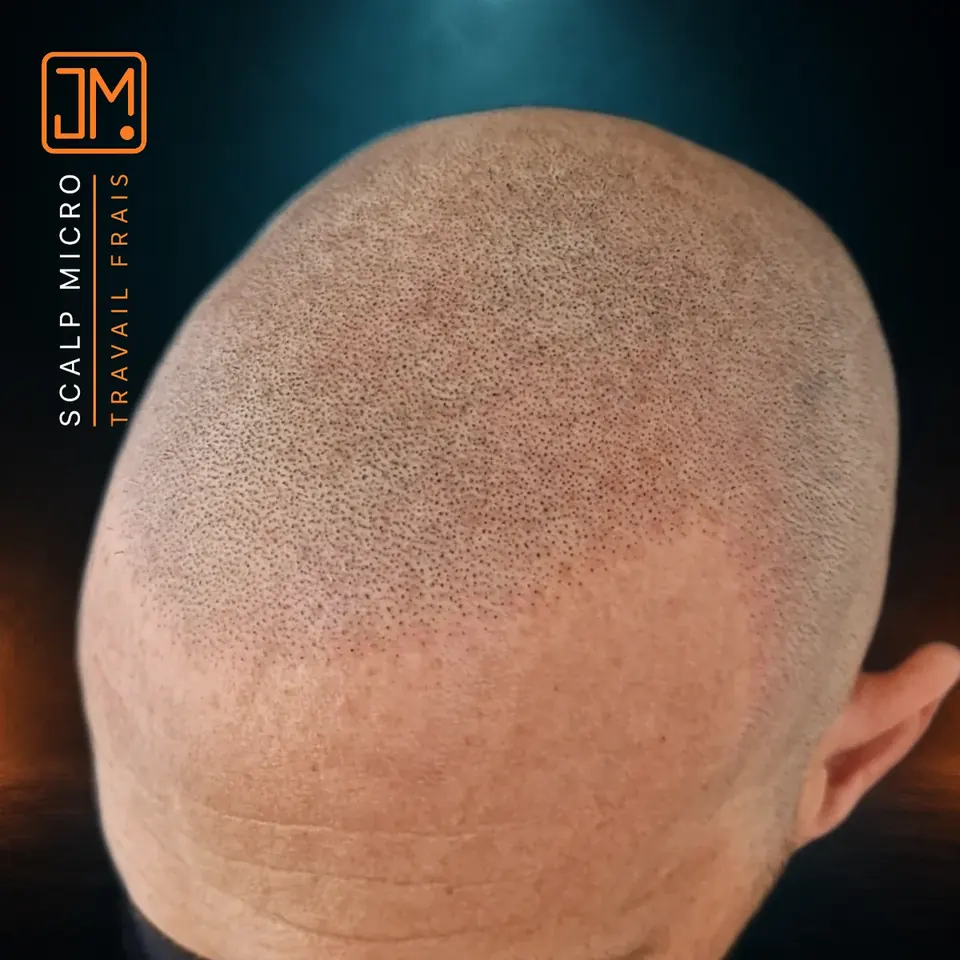 Micropigmentation capillaire JM.Micro, travail frais en gros plan