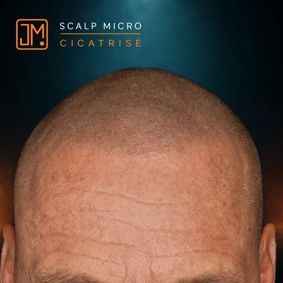 Résultat cicatrisé de micropigmentation capillaire JM.Micro — cas 22