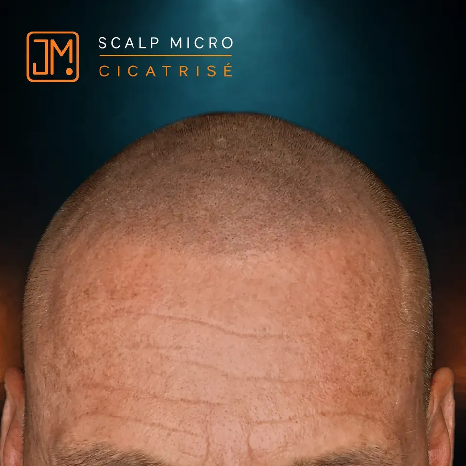Résultat cicatrisé de micropigmentation capillaire JM.Micro, cas 22